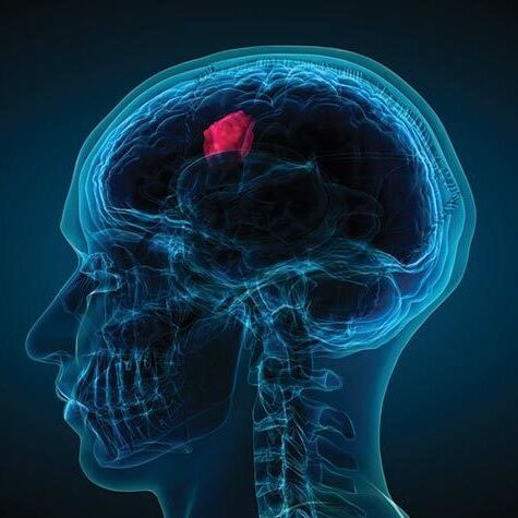 craniotomy-intro-image